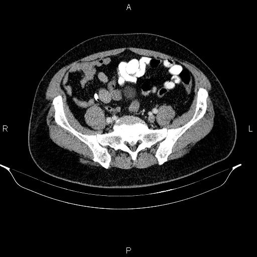 Acute pancreatitis (Radiopaedia 85390-101010 Axial C+ portal venous phase 81).jpg