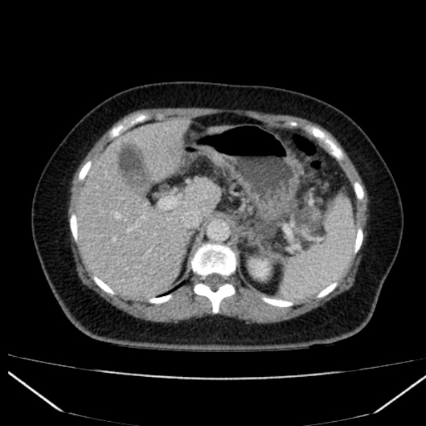 Acute pancreatitis - Balthazar C (Radiopaedia 26569-26714 Axial C+ portal venous phase 31).jpg
