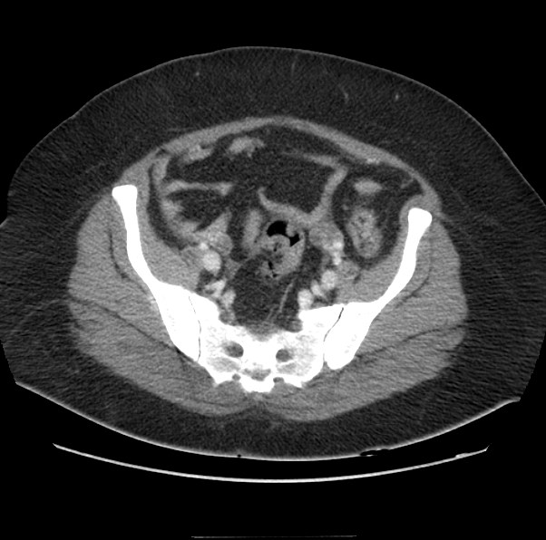 Acute pancreatitis - Balthazar E (Radiopaedia 29016-29377 Axial C+ portal venous phase 58).png