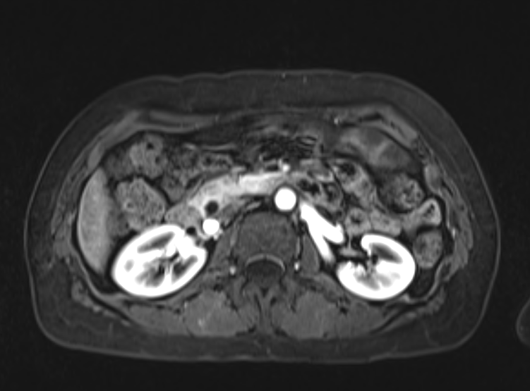 Acute pancreatitis - Balthazar E - post ERCP (Radiopaedia 27562-27778 Axial VIBE C+ 53).png