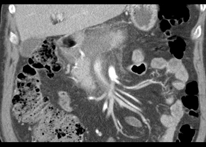 Acute pancreatitis and walled-off necrosis (Radiopaedia 29888-30403 Coronal C+ portal venous phase 23).jpg