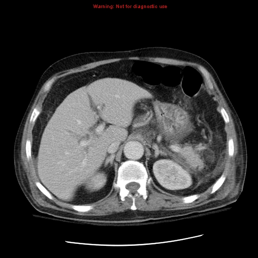 File:Acute pancreatitis with incidental pancreatic lipoma (Radiopaedia 10190-10730 Axial C+ portal venous phase 17).jpg