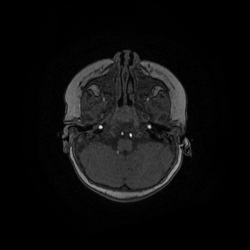 Acute phase of hemiconvulsion-hemiplegia epilepsy syndrome (Radiopaedia 29309-29745 Axial TOF angiography 129).jpg