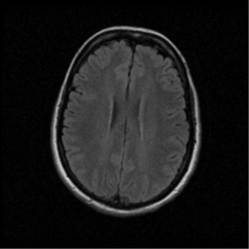 File:Acute pontine infarct from vertebral artery dissection (Radiopaedia 34111-35370 Axial FLAIR 14).png