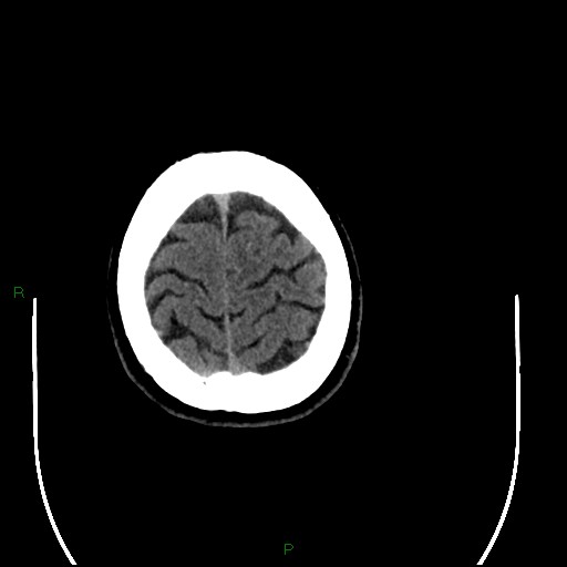 Acute posterior cerebral artery territory infarct (Radiopaedia 79329-92393 Axial non-contrast 100).jpg