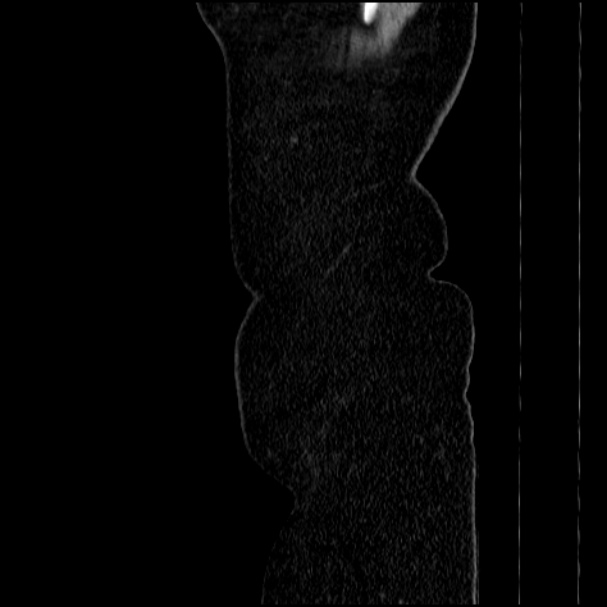 Acute pyelonephritis (Radiopaedia 33397-34434 Sagittal renal parenchymal phase 5).jpg