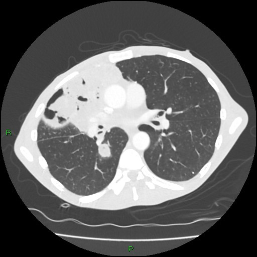 Acute right lung abscess (Radiopaedia 34806-36258 Axial lung window 93).jpg