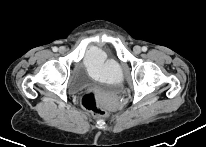 Acute small bowel (ileal) volvulus (Radiopaedia 71740-82139 Axial C+ portal venous phase 187).jpg