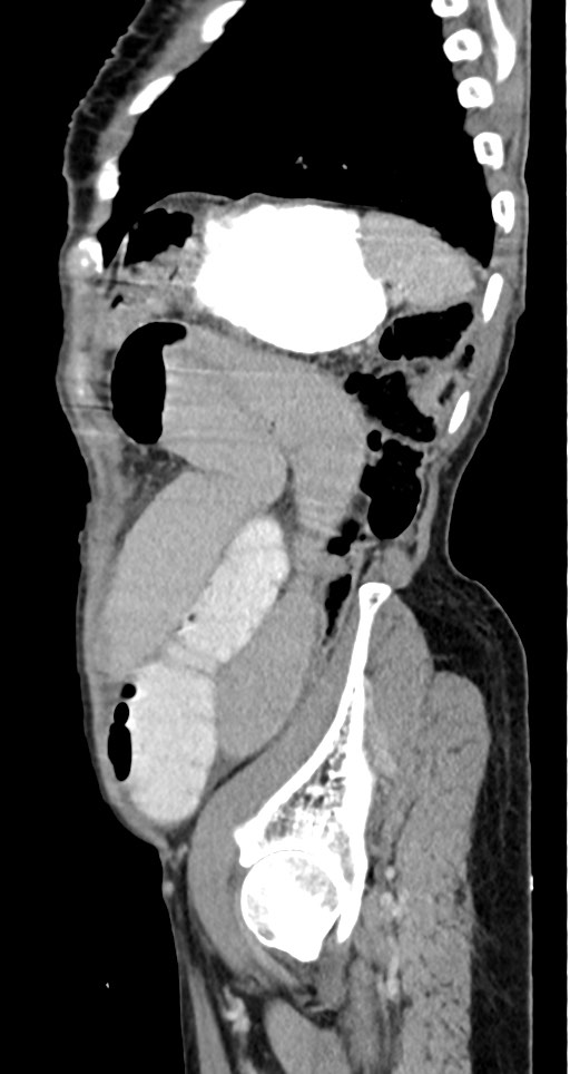 Acute small bowel (ileal) volvulus (Radiopaedia 71740-82139 Sagittal C+ portal venous phase 44).jpg