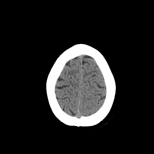 Acute subarachnoid hemorrhage and accessory anterior cerebral artery (Radiopaedia 69231-79008 Axial non-contrast 47).jpg