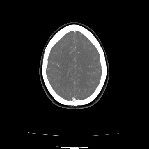 Acute subarachnoid hemorrhage and accessory anterior cerebral artery (Radiopaedia 69231-79009 Axial C+ arterial phase 112).jpg