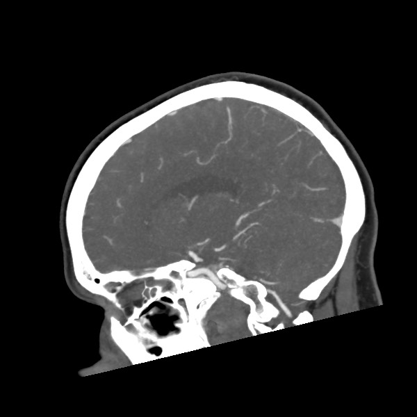 Acute subarachnoid hemorrhage and accessory anterior cerebral artery (Radiopaedia 69231-79009 Sagittal C+ arterial phase 32).jpg