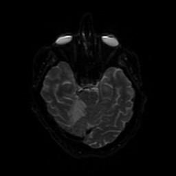 Acute superior cerebellar artery territory infarct (Radiopaedia 84104-99358 Axial DWI 88).jpg