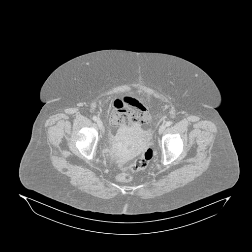 Acute superior mesenteric artery occlusion (Radiopaedia 51288-56960 Axial lung window 70).jpg