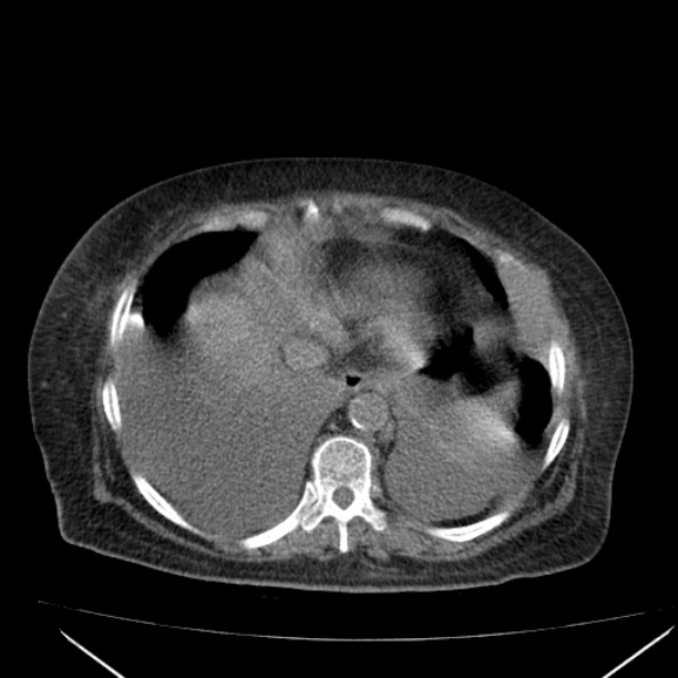 Acute tubular necrosis (Radiopaedia 28077-28334 Axial non-contrast 11).jpg