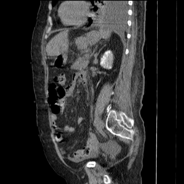 Acute tubular necrosis (Radiopaedia 28077-28334 Sagittal non-contrast 57).jpg