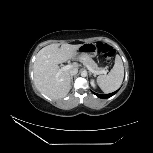 Acute uncomplicated appendicitis (Radiopaedia 73704-84499 Axial C+ portal venous phase 39).jpg