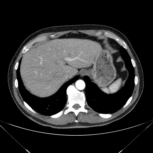 File:Adenocarcinoma of the lung (Radiopaedia 59871-67325 Axial C+ arterial phase 82).jpg