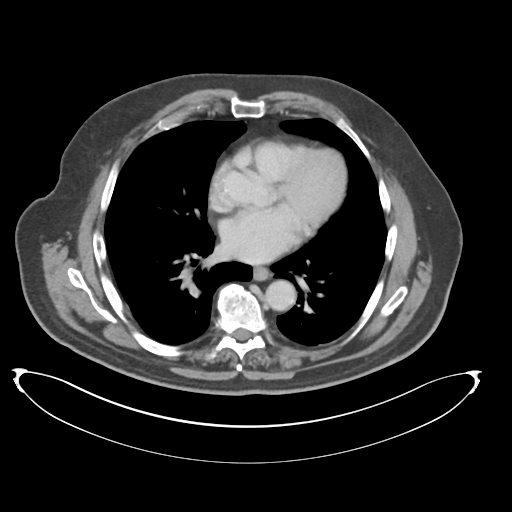 File:Adenocarcioma of rectum- T1 lesion (Radiopaedia 36921-38547 Axial C+ portal venous phase 2).png