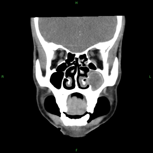File:Adenoid cystic carcinoma of hard palate (Radiopaedia 26137-26273 Coronal liver window 8).jpg
