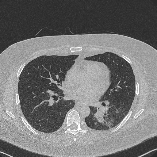 Adenoid cystic carcinoma of the trachea (Radiopaedia 49042-54137 Axial lung window 194).jpg