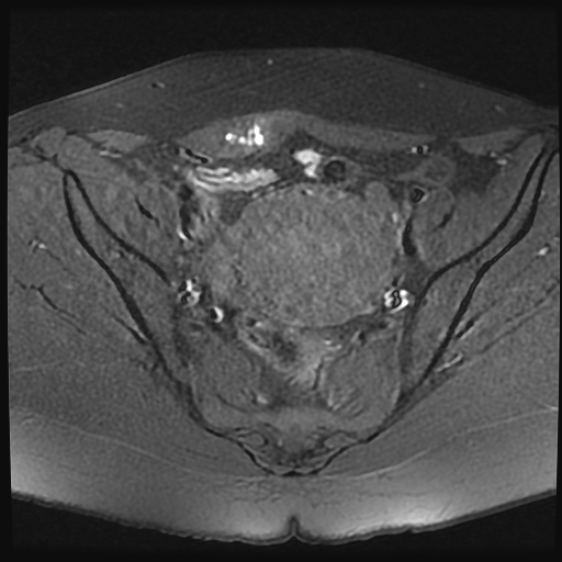 File:Adenomyosis-scar endometriosis (Radiopaedia 65863-75022 Axial T1 fat sat 11).jpg