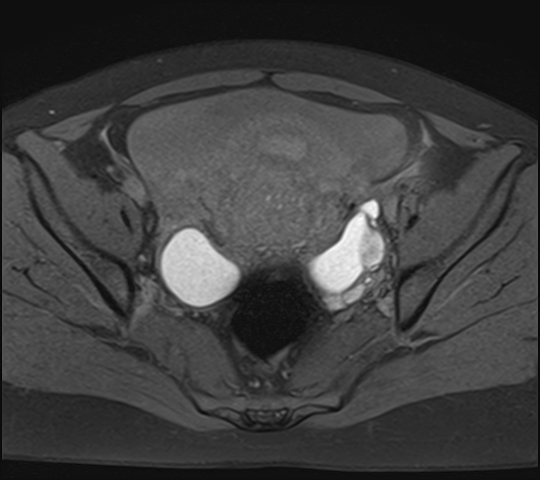 File:Adenomyosis - ovarian endometriomas (Radiopaedia 67031-76350 Axial T1 fat sat 14).jpg