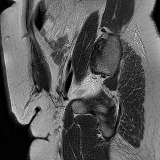File:Adenomyosis within a didelphys uterus (Radiopaedia 70175-80215 Sagittal T2 6).jpg