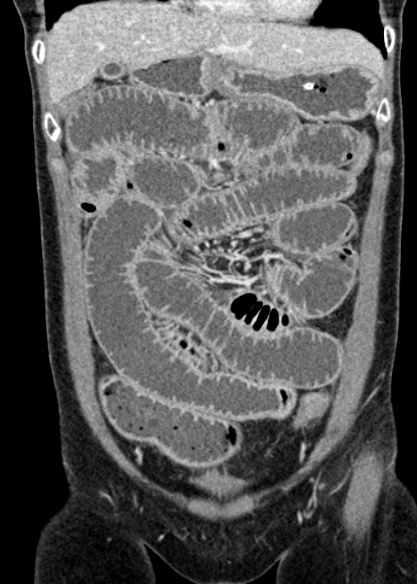 Adhesional small bowel obstruction (Radiopaedia 48397-53305 Coronal C+ portal venous phase 104).jpg