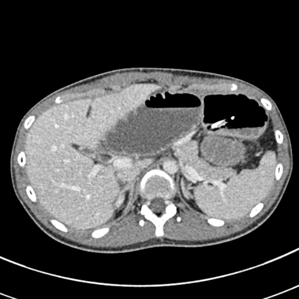 Adhesional small bowel obstruction (Radiopaedia 52107-57980 Axial C+ portal venous phase 25).jpg