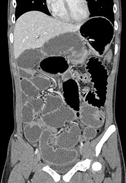 Adhesional small bowel obstruction (Radiopaedia 52107-57980 Coronal C+ portal venous phase 27).jpg