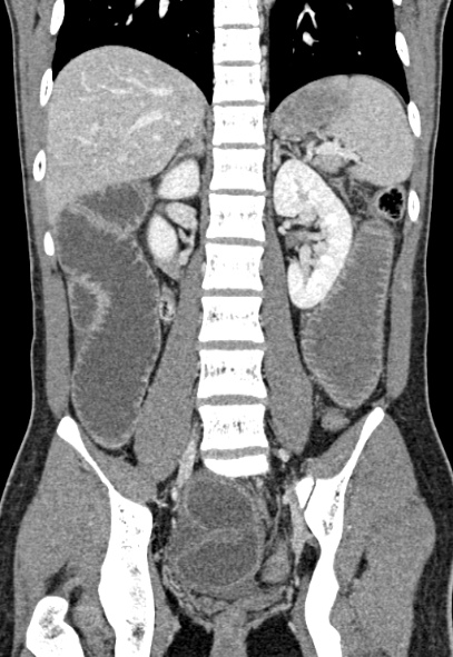 Adhesional small bowel obstruction (Radiopaedia 52107-57980 Coronal C+ portal venous phase 52).jpg