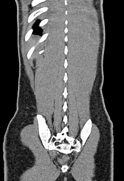 Adhesional small bowel obstruction (Radiopaedia 52107-57980 Coronal C+ portal venous phase 72).jpg