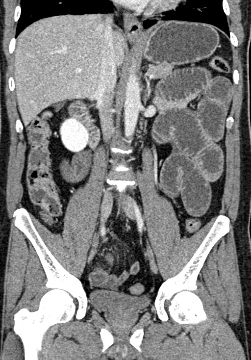 Adhesional small bowel obstruction (Radiopaedia 58900-66131 Coronal C+ portal venous phase 147).jpg