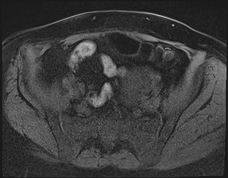 File:Adnexal multilocular cyst (O-RADS US 3. O-RADS MRI 3) (Radiopaedia 87426-103754 Axial 207).jpeg