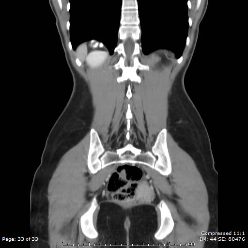 File:Adrenal calcification (Radiopaedia 55755-62314 Coronal C+ portal venous phase 33).jpg