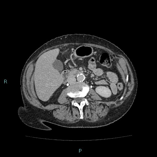 File:Adrenal collision tumor (ACT) (Radiopaedia 48462-53379 Axial C+ delayed 32).jpg