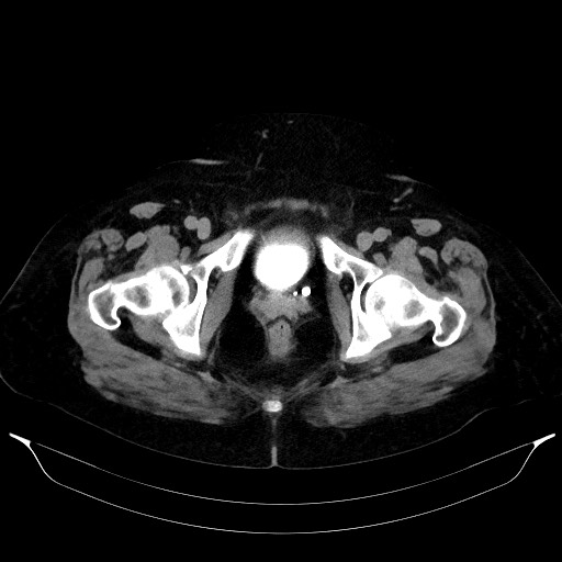 Adrenal cortical carcinoma (Radiopaedia 64017-72769 Axial C+ delayed 77).jpg