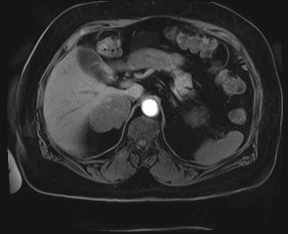 Adrenal cortical carcinoma (Radiopaedia 64017-72770 Axial T1 C+ fat sat 6).jpg