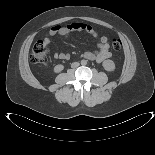 Adrenal cyst (Radiopaedia 45625-49778 Axial non-contrast 70).png