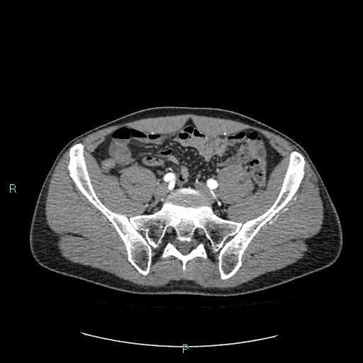 Adrenal cystic lymphangioma (Radiopaedia 83161-97534 Axial C+ arterial phase 72).jpg