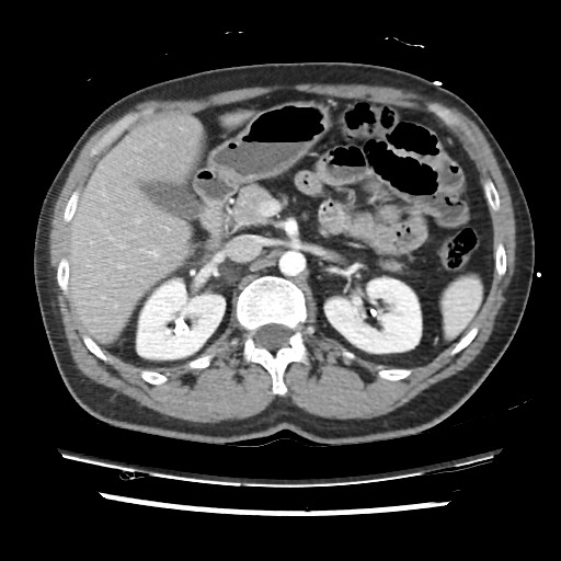 File:Adrenal gland trauma (Radiopaedia 81351-95078 Axial Dual bolus trauma C+ 68).jpg