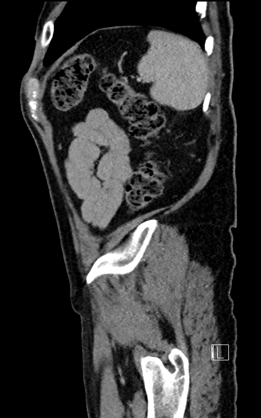 Adrenal lymphoma (Radiopaedia 73730-84529 Sagittal C+ portal venous phase 96).jpg