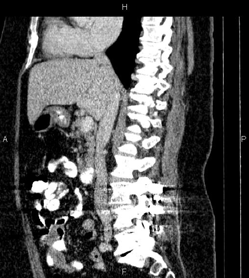 Adrenal myelolipoma (Radiopaedia 84319-99617 Sagittal renal cortical phase 43).jpg