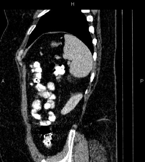 Adrenal myelolipoma (Radiopaedia 84319-99617 Sagittal renal cortical phase 82).jpg