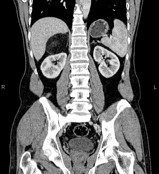 Adrenal myelolipoma (Radiopaedia 87794-104246 Coronal renal cortical phase 43).jpg