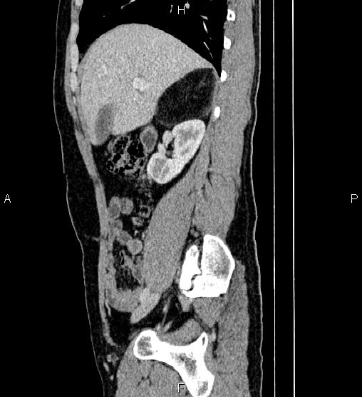 Adrenal myelolipoma (Radiopaedia 87794-104246 Sagittal renal cortical phase 30).jpg