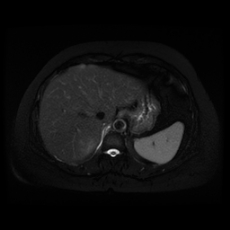 File:Adrenal myelolipoma - MRI (Radiopaedia 83249-97646 Axial STIR 8).jpg