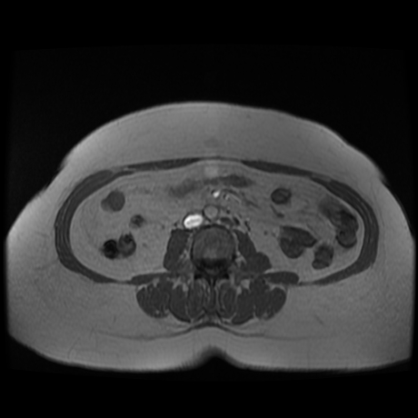 File:Adrenal myelolipoma - MRI (Radiopaedia 83249-97646 Axial T1-in phase 24).jpg