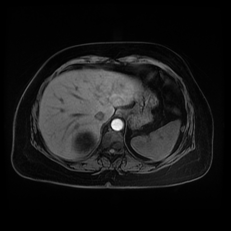 Adrenal myelolipoma - MRI (Radiopaedia 83249-97646 Axial T1 fat sat 10).jpg